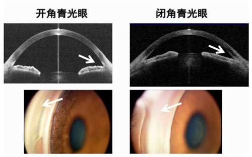 开,闭角青光眼的as-oct影像和retcam影像(箭头标示的为前房角位置)